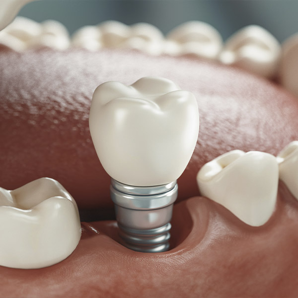 Implantes Dentales en Zaragoza Clínica Dental Nordent