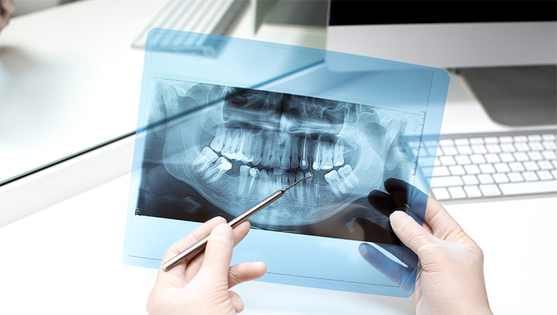Consecuencias de la pérdida de una pieza dental